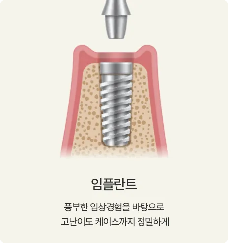 임플란트