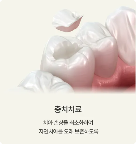 충치치료