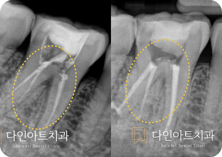 재신경치료