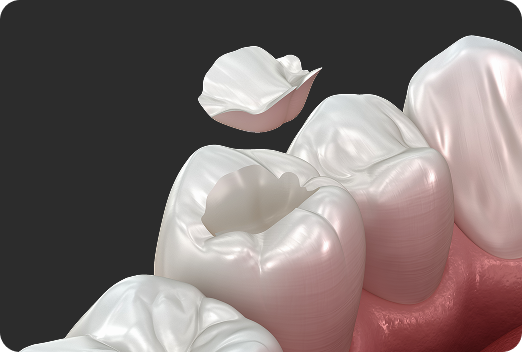 보철치료 3D이미지