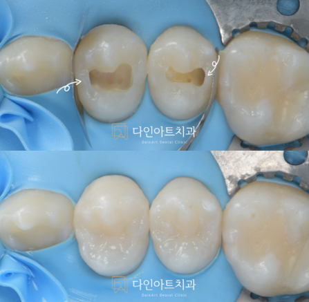 12세 환자의 인접면 우식, 최소침습 레진빌드업으로 치료한 증례
